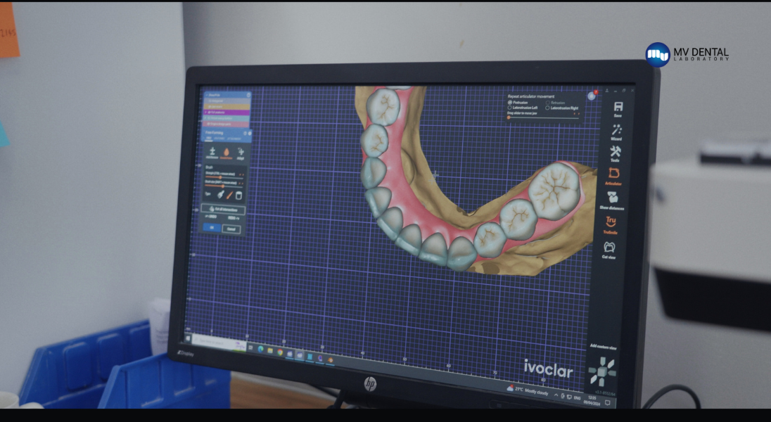 All-on-X Smile Design for Dentate Patient Protocol