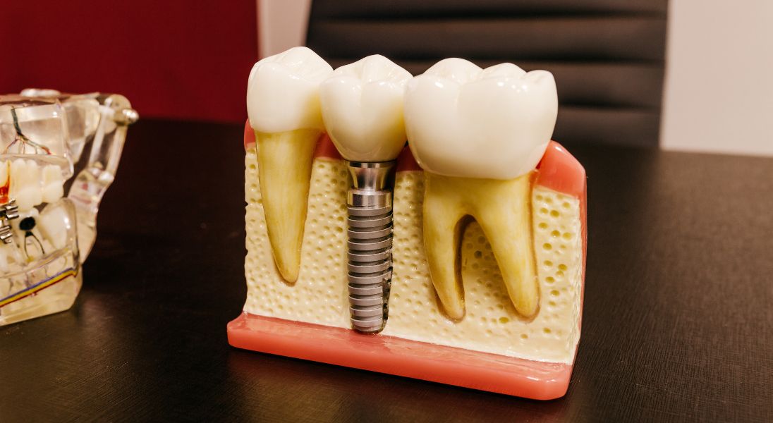 an image showing implant abutment