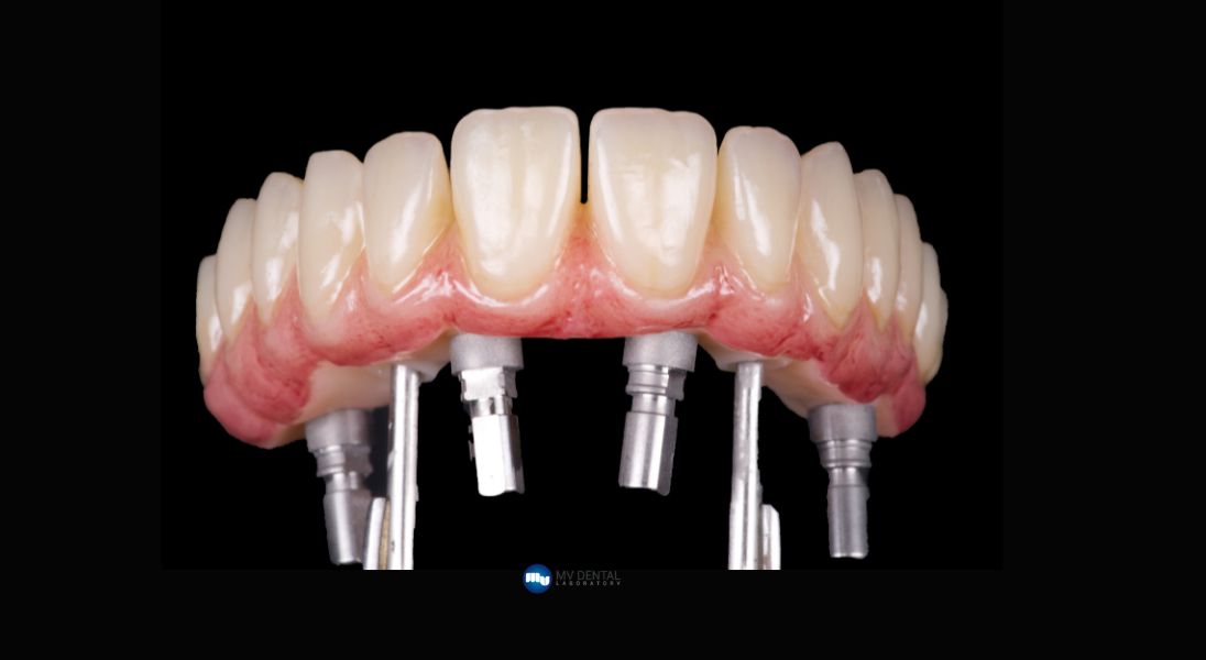 dental implant all-on-x
